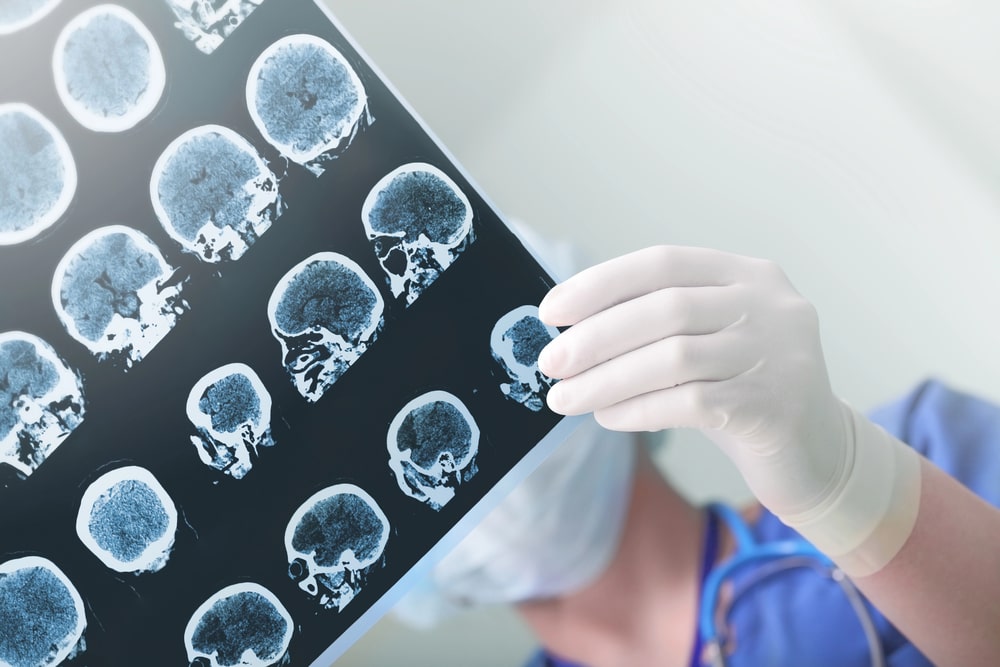 Traumatic Brain Injury Lawyer Falls Church, VA