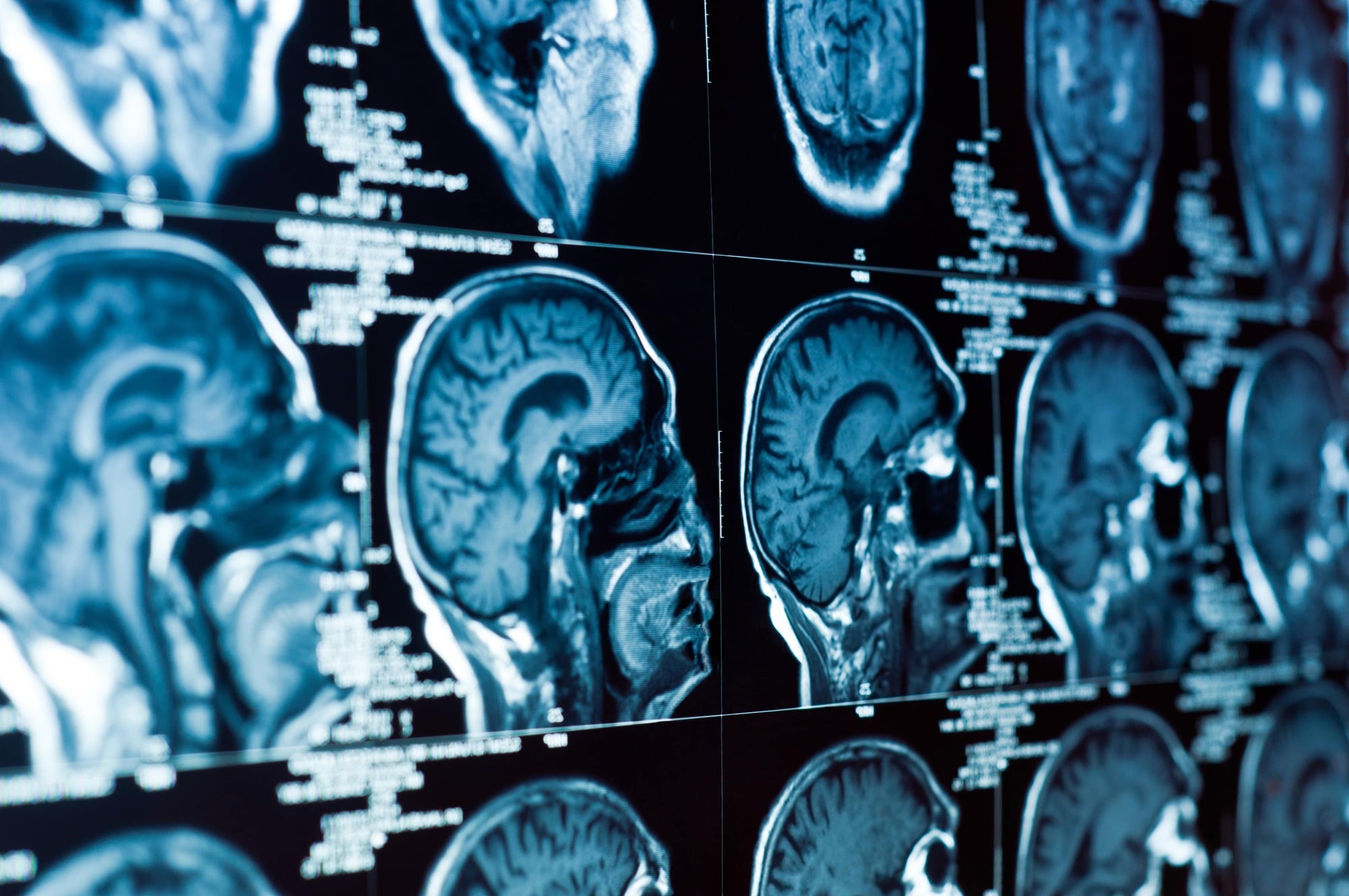 Traumatic Brain Injury Lawyer Vienna, VA